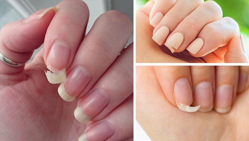 Thiếu canxi còn làm cho móng tay giòn, da khô, đàn hồi kém