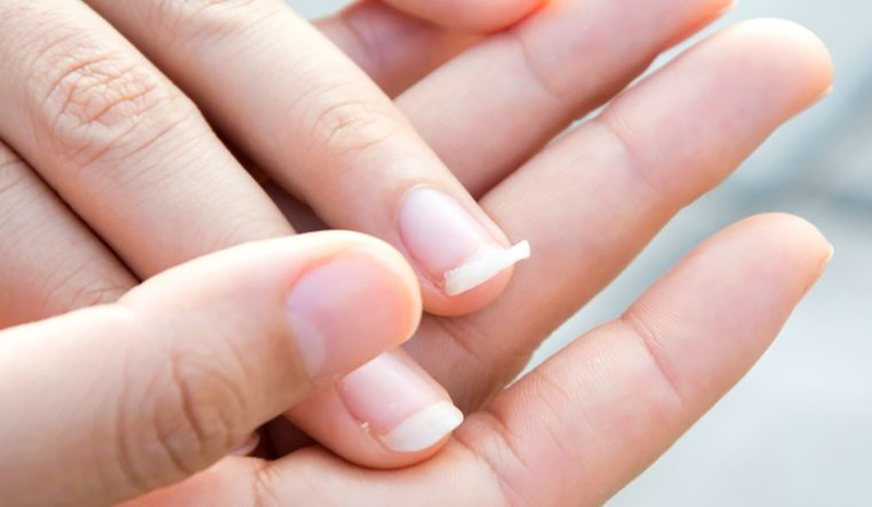 Thiếu canxi còn làm cho móng tay giòn, da khô, đàn hồi kém