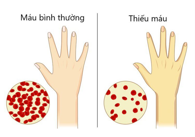 Không cung cấp đủ sắt dễ khiến bạn bị thiếu máu