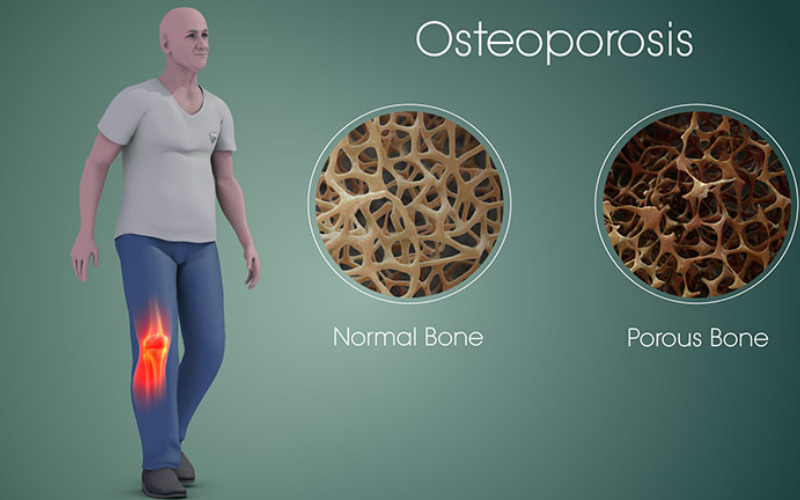 Các dấu hiệu giúp bạn nhận biết bệnh loãng xương