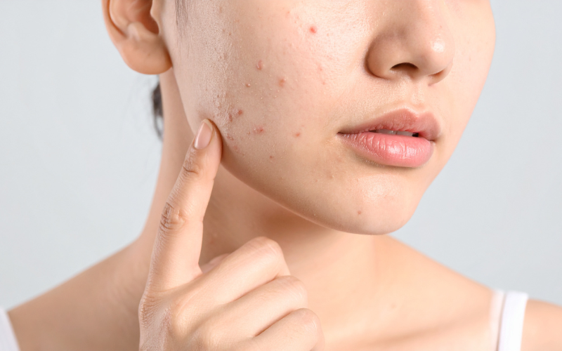 Da mụn là tình trạng da bị bít tắc lỗ chân lông do bã nhờn và vi khuẩn Cutibacterium acnes